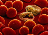 Хроническая малярия